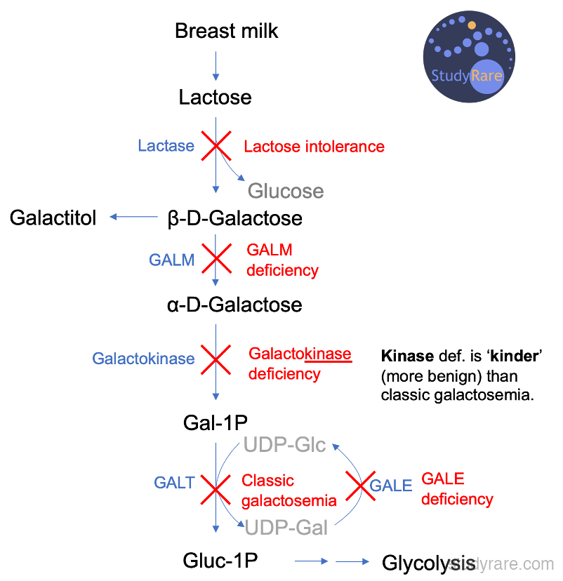 Galactose metabolism pathway: lactose to galactose conversion via galactokinase, GALT, and GALE, with classic galactosemia caused by GALT deficiency
