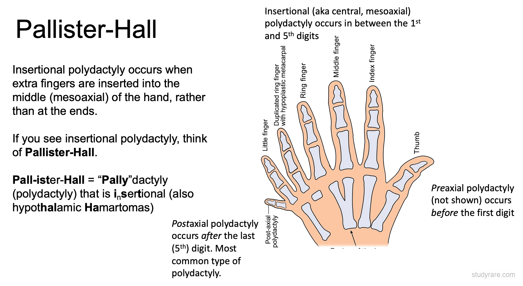 Pallister-Hall syndrome: central/insertional polydactyly with hand skeletal anatomy showing duplicated digit