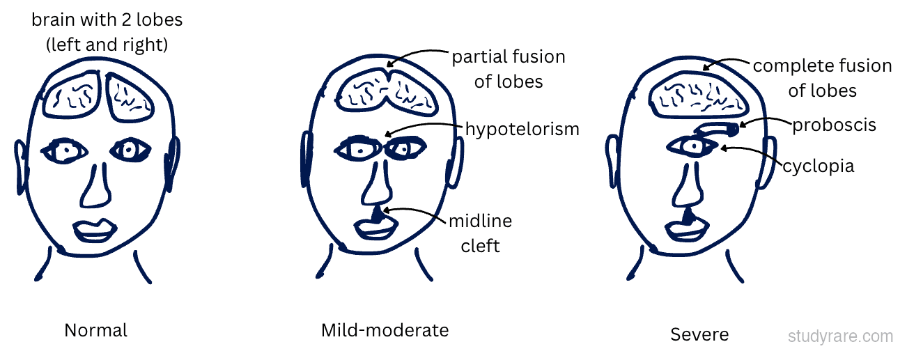 The face predicts the brain - midline defects reflect underlying brain malformation