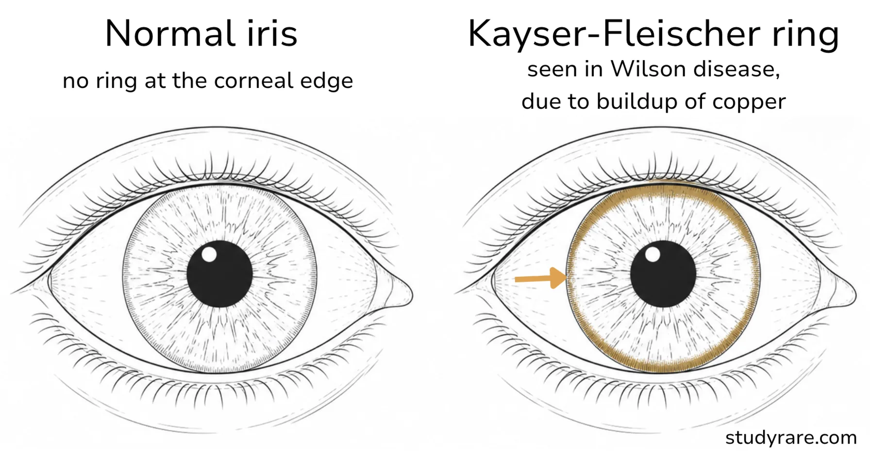 A normal iris next to the Kayser-Fleischer ring of Wilson disease, a golden-brown band of copper circling the outer edge of the cornea