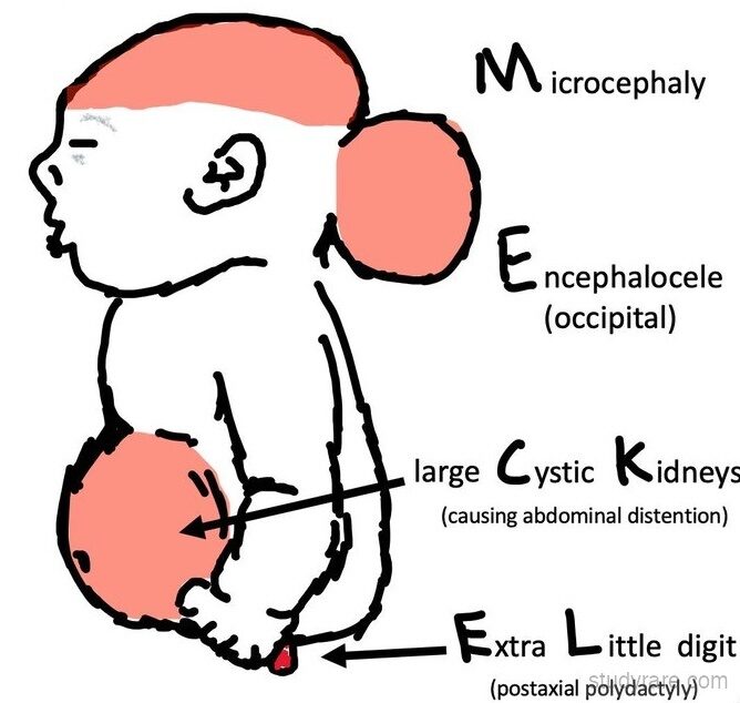 Meckel-Gruber syndrome