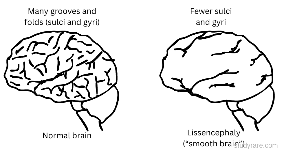 Miller-Dieker: smooth brain (lissencephaly) from 17p13.3 deletion
