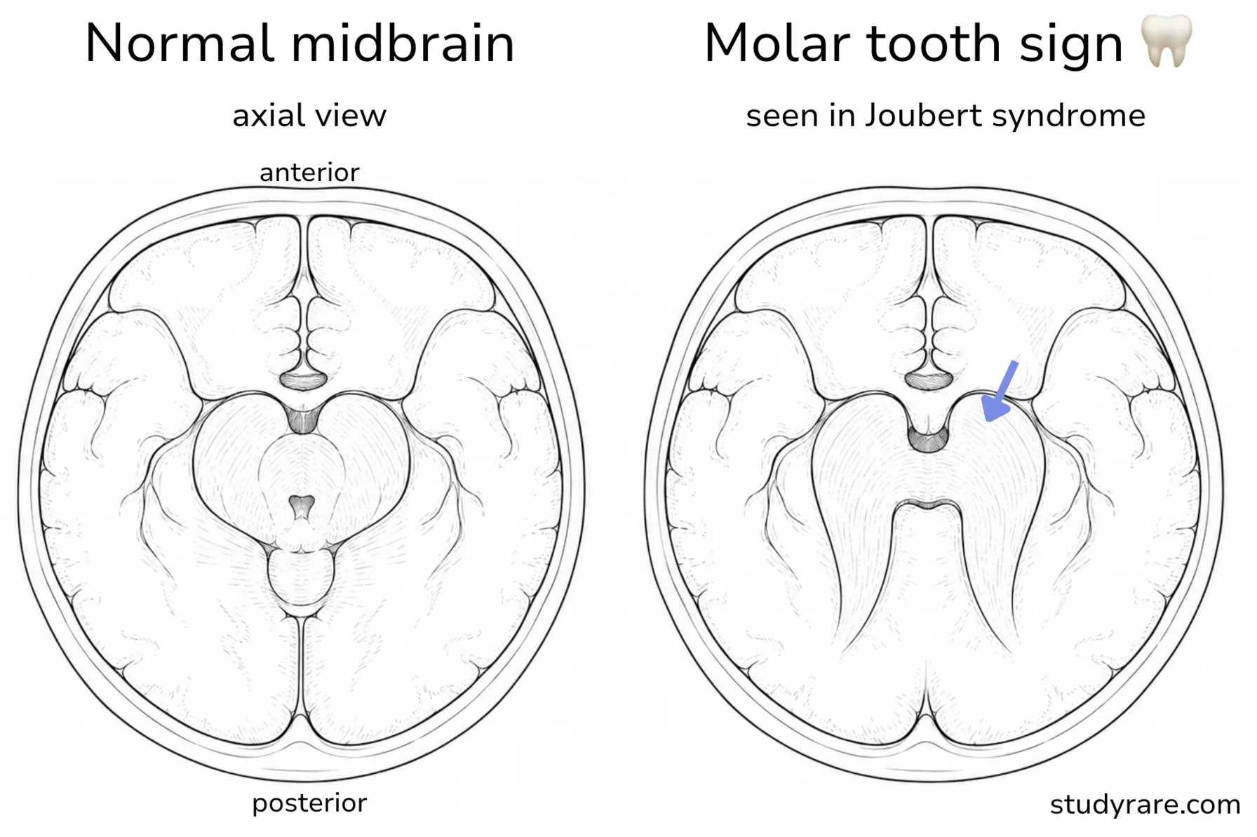 A normal midbrain on axial MRI next to the molar tooth sign of Joubert syndrome, where thick superior cerebellar peduncles and a deep interpeduncular fossa outline a molar