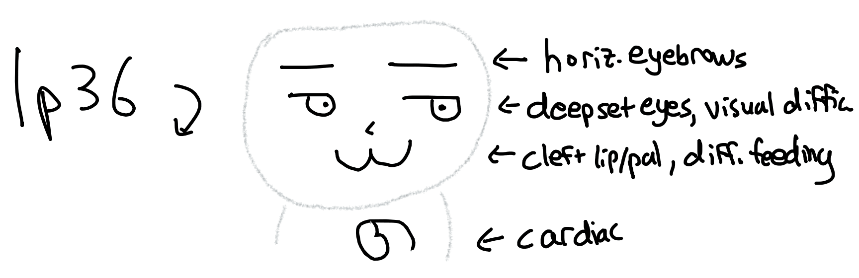 1p36 deletion face mnemonic: straight (horizontal) eyebrows, deep-set eyes with cortical visual impairment, cleft lip/palate and feeding difficulty, and cardiac involvement (LVNC, structural CHD)