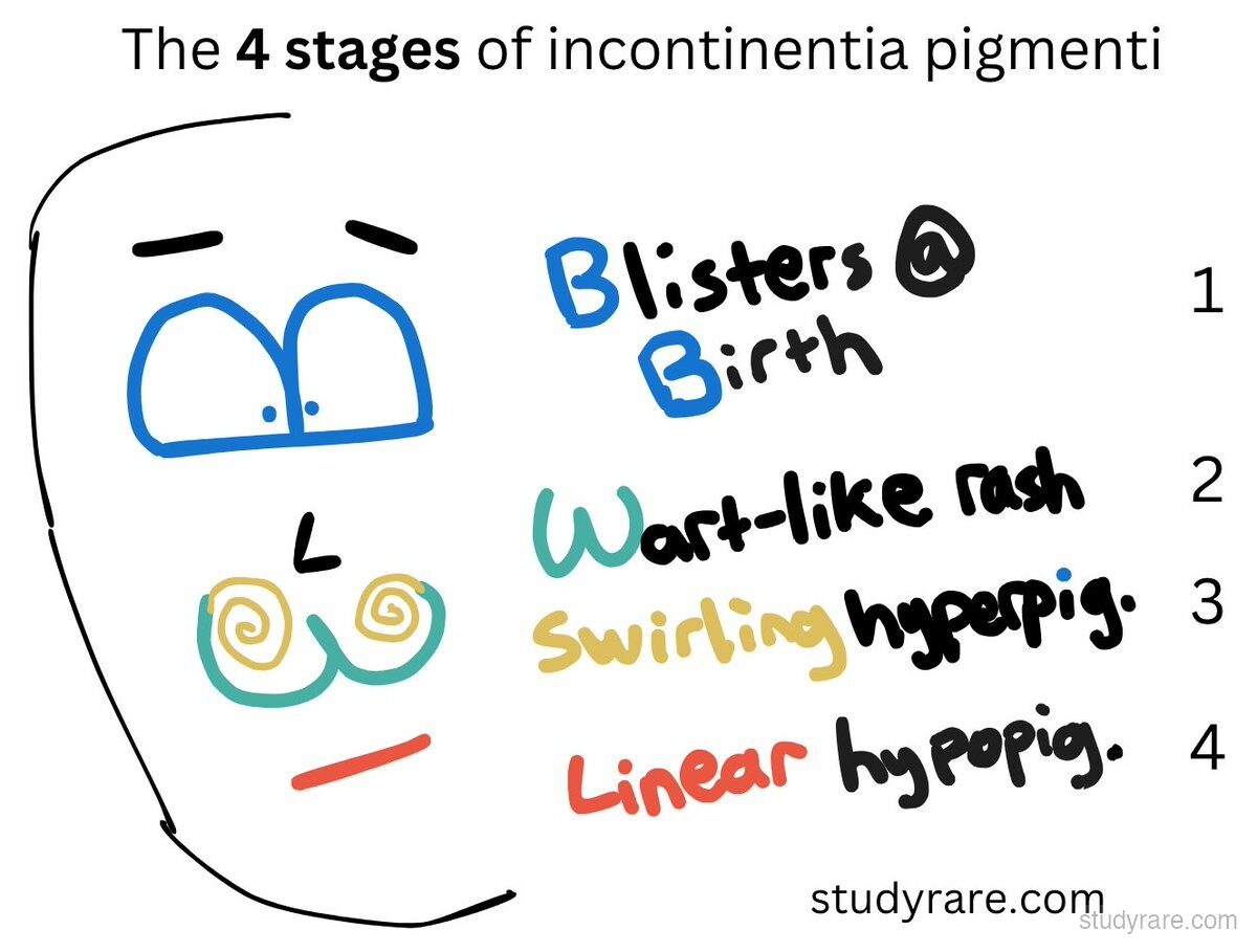 Incontinentia pigmenti 4 stages illustrated: stage 1 blisters at birth, stage 2 wart-like rash, stage 3 swirling hyperpigmentation, stage 4 linear hypopigmentation