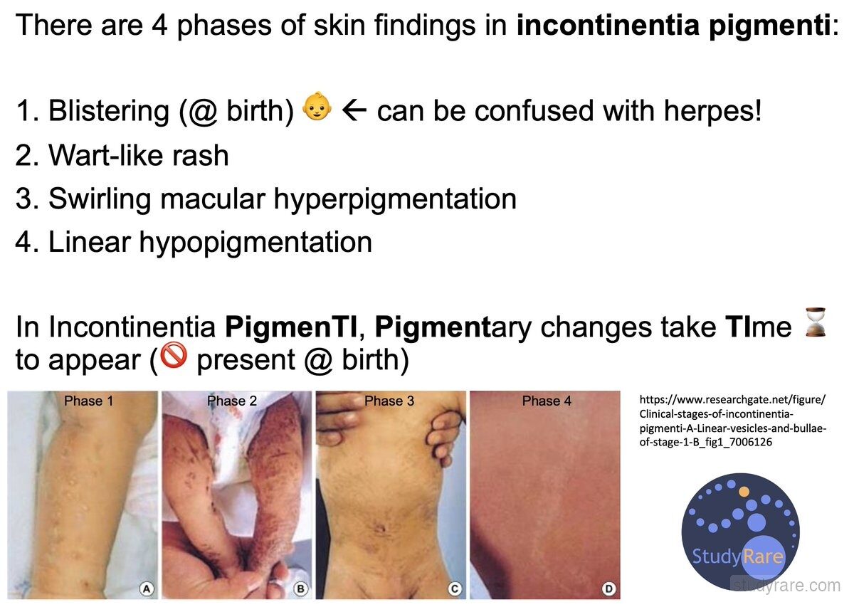 Incontinentia pigmenti skin phases with clinical photos: blistering at birth (can mimic herpes), wart-like rash, swirling macular hyperpigmentation, and linear hypopigmentation